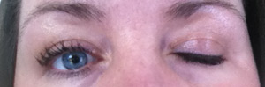 Symtom fallande ögonlock vid Myastenia Gravis